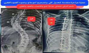 لأول مرة في عدن.. إجراء عملية جراحية متقدمة لتصحيح تشوه و اعوجاج العمود الفقري بنجاح باهر
