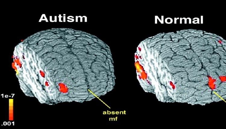 العلماء الروس يكتشفون علاقة بين بنية الدماغ ومرض التوحد لدى الأطفال
